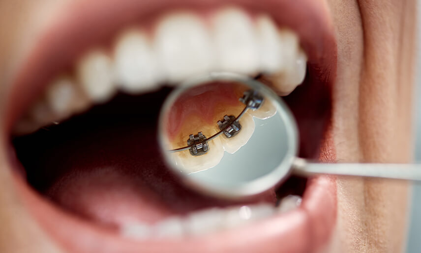 Are There Braces That Go Behind Your Teeth? A Guide to Lingual Braces