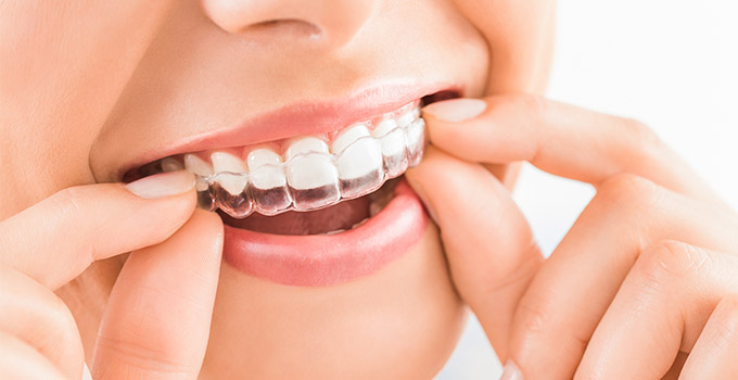  What is Invisalign® treatment?