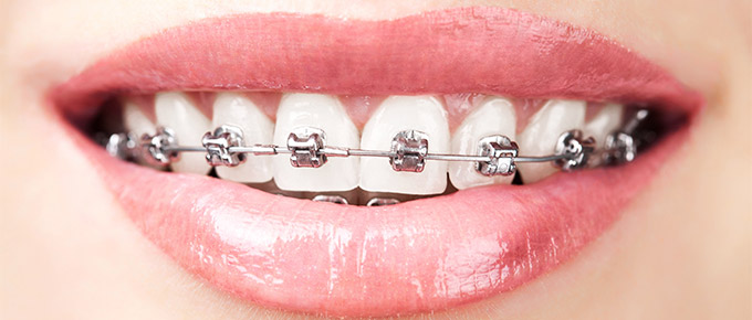  What are metal braces?