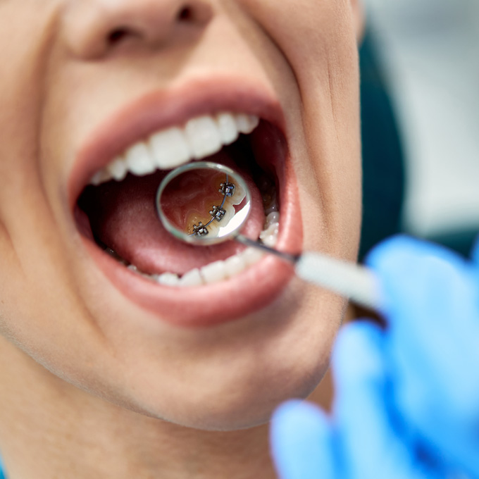  Book your free consultation for lingual braces in Manchester