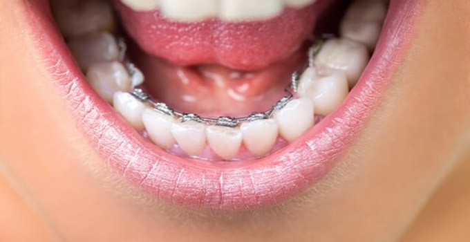  What are lingual braces?