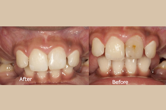  Enamel discolouration treatment for children