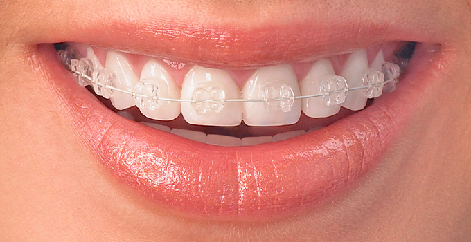  What are ceramic braces?